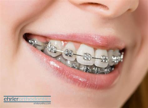 Ensuring Comfort with Witching Smile Teeth Braces